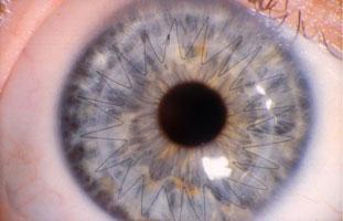 Corneal Transplant