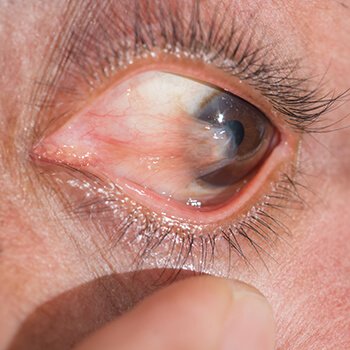 Pterygium