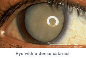 Eye with a dense cataract