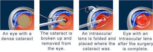 1. An eye with a dense cataract. 2. The Cataract is broken up and removed from the eye. 3. An intraocular lens is folded and placed where the cataract was. 4. Eye with an intraocular lens after the surgery is complete.