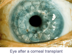 Cornea Transplant Beverly Hills Corneal Transplant Procedure