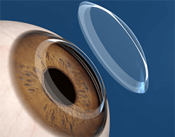 Cornea Transplant Beverly Hills Cornea Transplant Diagram