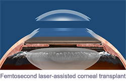 Femtosecond laser-assisted corneal transplant