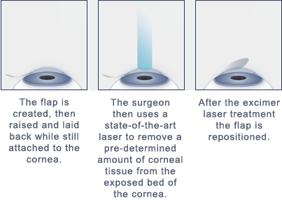 1. The flap is created, then raised and laid back while still attached to the cornea. 2. The surgeon then uses a state-of-the-art laser to remove a predetermined amount of corneal tissue from the exposed bed of the cornea. 3. After the excimer laser treatment the flap is repositioned.