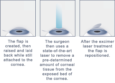 LASIK Eye Surgery Beverly Hills LASIK Eye Surgery Procedure