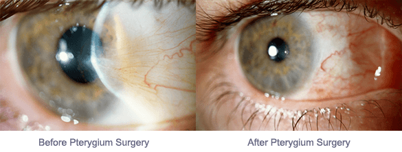Pterygium surgery before and after.