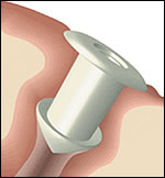 A punctual plug in a tear duct.