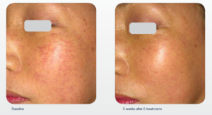 Rosacea treatment over the course of 5 weeks.