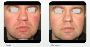 Rosacea treatment before and after.