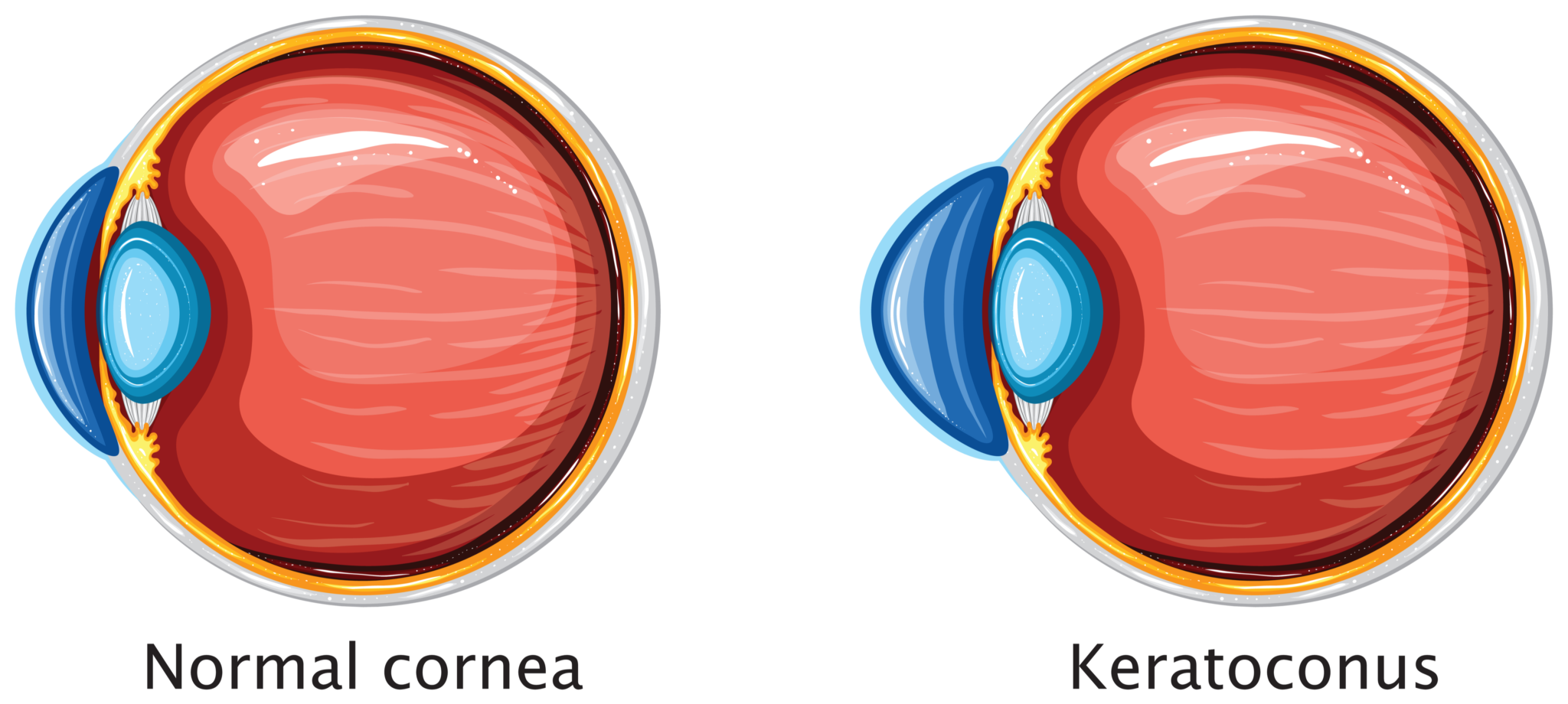 Cornea Beverly Hills Cornea CrossLinking Orange County Gaster Eye